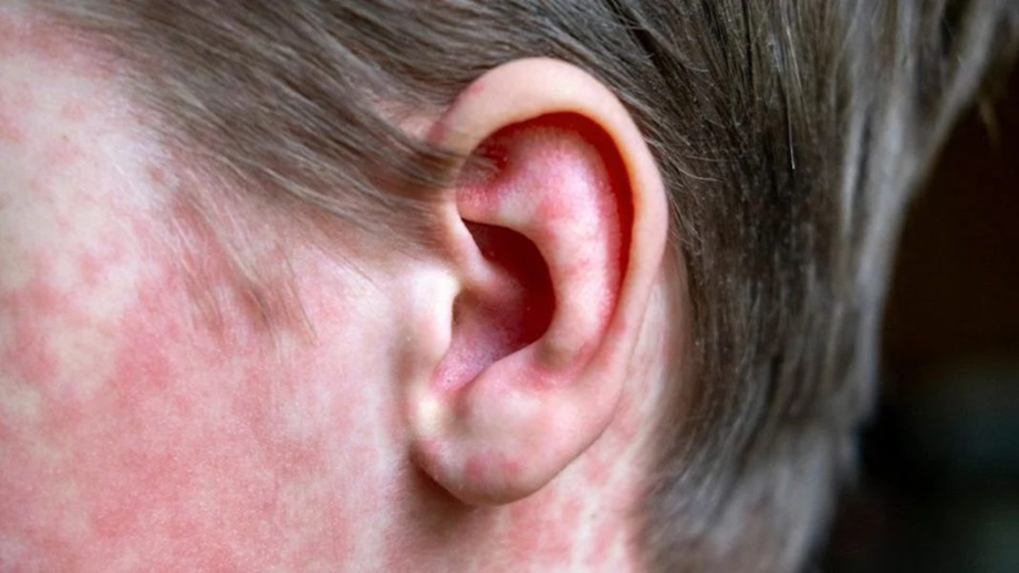 PRI Estado de México señala a Morena por el regreso del sarampión en el país