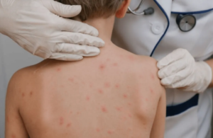 PRI Estado de México señala retroceso sanitario tras regreso del sarampión