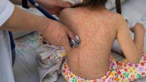 Reportan nueva muerte por sarampión en México